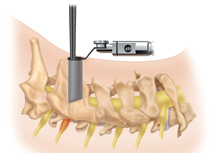 Cervical Posterior Foraminotomy