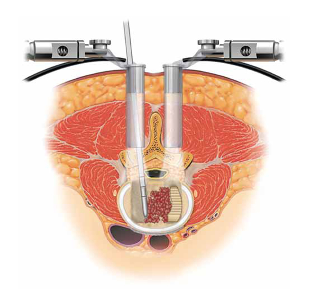PLIF: Posterior Lumbar Interbody Fusion